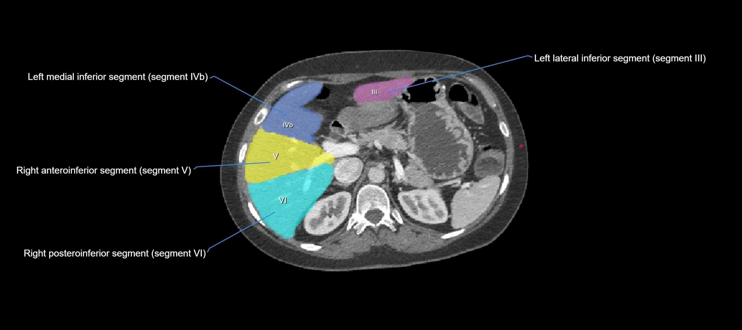 CT liver segments axial cross sectional anatomy labelled image-00042.webp